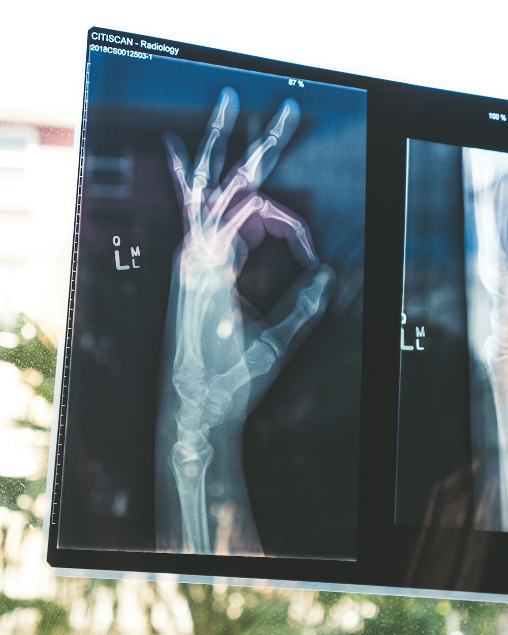 DeepECG telemetria ed elettrocardiografia